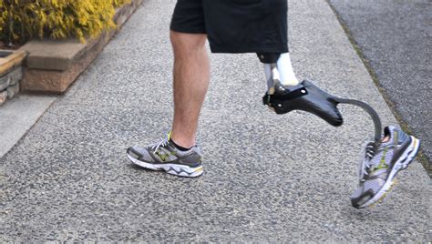 Amputation vs. Limb Salvage — Prosthetic Leg