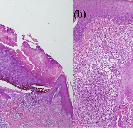 Histopathology of a pustular lesion from the left lower extremity ...