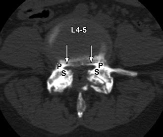 Lateral Recess Stenosis | Radiology Key