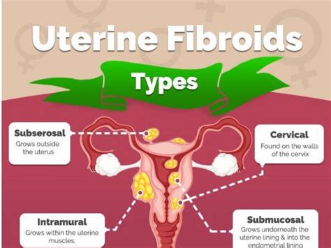 Uterine Fibroids Types, Symptoms & Treatments (Infographic)