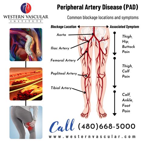 Common PAD blockage sites and symptoms in 2021 | Peripheral artery disease, Vascular, Vascular ...