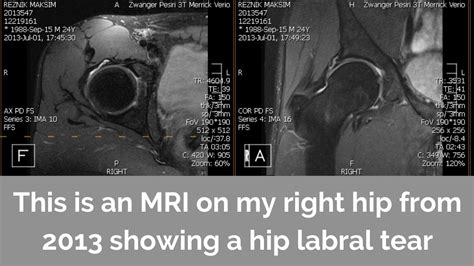 Why Your Hip Labrum Tear Diagnosis Shouldn't Scare You. (2023)