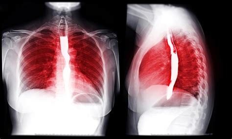 Cary Gastroenterology Associates | Why Might I Need a Barium Swallow…