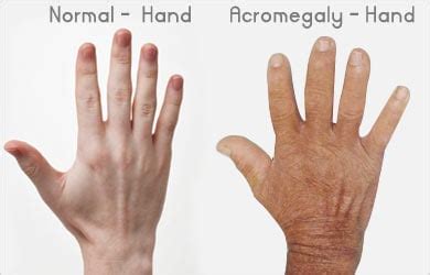 Acromegaly - Causes Symptoms Complications Diagnosis Treatment Prognosis