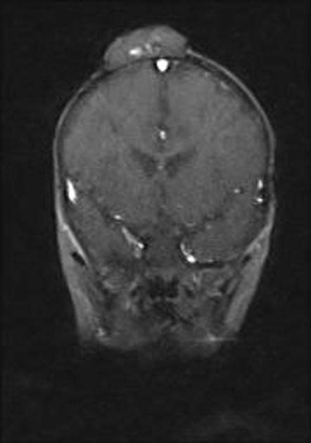 Sinus pericranii | Radiology Case | Radiopaedia.org | Radiology ...