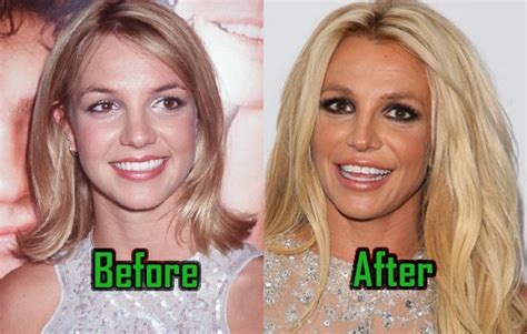 Britney Spears: Plastic Surgery Behind Her Unusual Look, Before-After! - CelebritySurgeryIcon