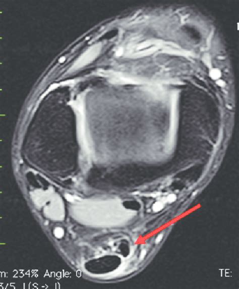 Plantaris Muscle Mri