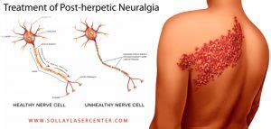 Treatment of Post-herpetic Neuralgia (Nerve Pain After Shingles Attack) - Sollay Cosmetic ...
