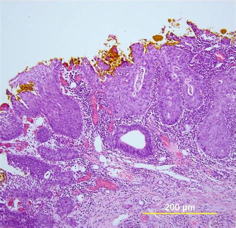 Adenocarcinoma: Cervical Adenocarcinoma In Situ