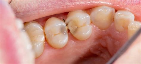 What Does a Cavity Look Like? | Mint Hill Dentistry