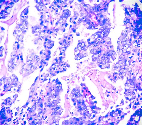 Biopsy from the gastroesophageal junction growth, showing... | Download ...