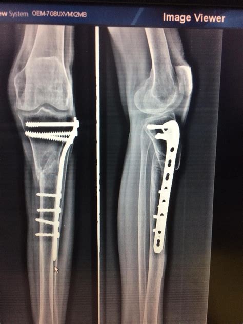 Tibial Shaft Fractures Trauma Orthobullets 74550 | The Best Porn Website