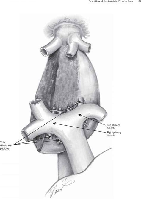 Resection of the Caudate Process Area - Glissonean Pedicle