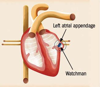 A device to prevent strokes in afib - Harvard Health