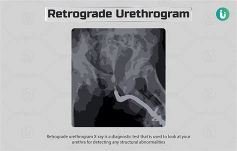 Retrograde urethrogram (RGU X-ray): Procedure, Purpose, Results, Normal ...