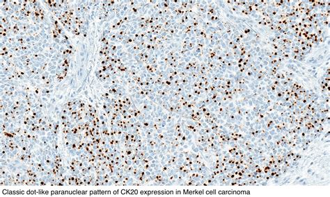 Pathology Outlines - Merkel cell carcinoma