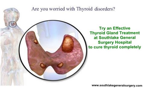 Thyroid treatment- Robotic treatment- Recovery after surgery | Southlake