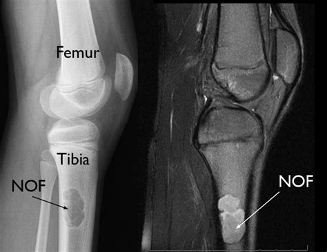 Nonossifying Fibroma - OrthoInfo - AAOS