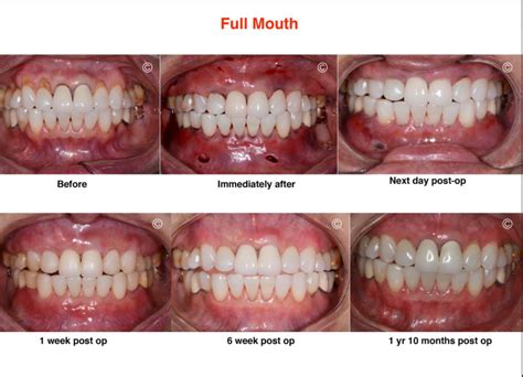 Pinhole Gum Rejuvenation® | Dental Gum Restoration in Alhambra, CA