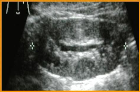 Grade 1 hydronephrosis on ultrasonography. Renal pelvis APD 1 cm and no... | Download Scientific ...