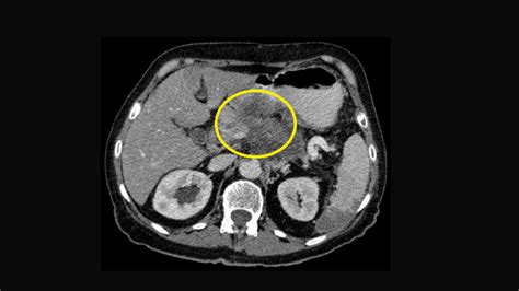 Normal Pancreas Cat Scan