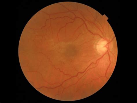 Epiretinal Membranes / Cellophane Maculopathy – Mr. Kirti M Jasani