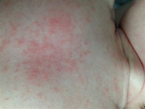 Rash? What is this?? Pic included | BabyCenter