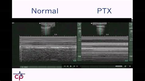 Critical Points: beside ultrasound for pneumothorax - YouTube