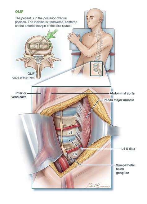 OLIF Spine Surgery | Barrow Neurological Institute