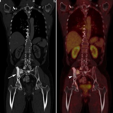 Radiodiagnosis - Imaging is Amazing-Interesting cases: Carcinoma Prostate - PET/CT