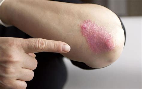 InfoPanda.net | Moderate to severe plaque psoriasis treatment