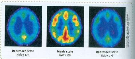 BiPolar Disorders