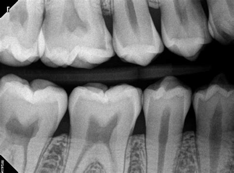 What Does a Cavity Look Like on an X-Ray? - Web DMD