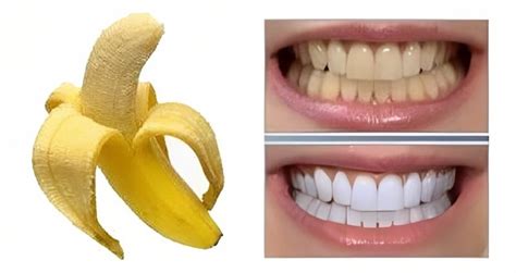 How To Whiten Your Teeth With Banana Peel: 3 Simple Steps