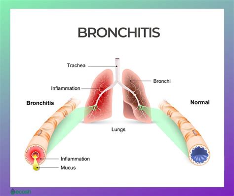 BRONCHITIS - Symptoms, Causes and 29 Home Remedies To Support Bronchitis Treatment - Ecosh