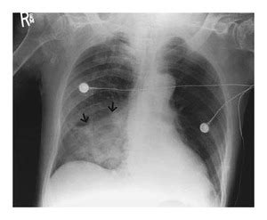 Pneumonia Vs Aspiration Pneumonia