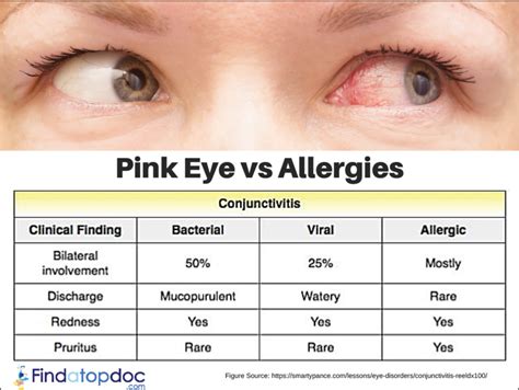 Pink Eye (Conjunctivitis): Symptoms, Causes, Treatment, and Diagnosis | FindATopDoc