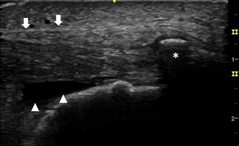 Long axis ultrasound image of Achilles tendon insertion with... | Download Scientific Diagram