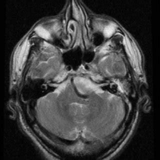 (PDF) Brainstem compression syndrome caused by vertebrobasilar ...