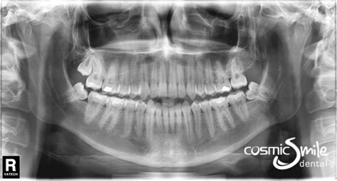 Panoramic Radiograph Sydney - Cosmic Smile Laser Dental