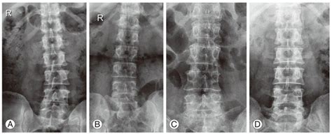 X-rays showing lumbosacral transitional vertebrae sacralisation (A),... | Download Scientific ...