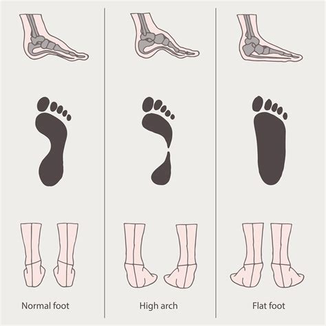 Why People with “High Arches” Can’t Find Orthotics That Work and How ...