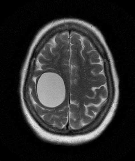 Neuroglial Cyst AKA Neuroepithelial Cysts - benign congenital cysts ...