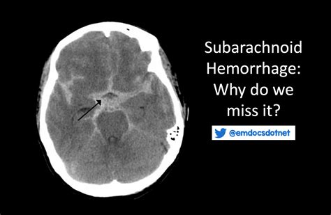 emDOCs.net – Emergency Medicine EducationSubarachnoid Hemorrhage: Why do we miss it? - emDOCs ...