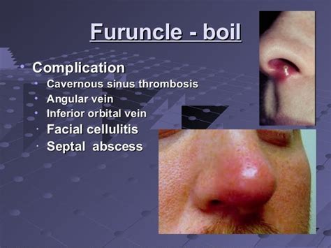 Nasal Vestibulitis Pictures - Nose Endoscopy : Vestibulitis due to ...