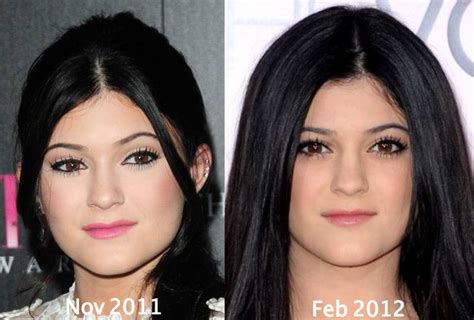 Kylie Jenner Plastic Surgery Before and After Eyebrows