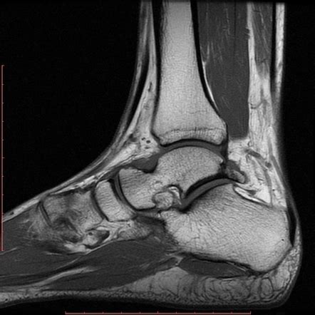 Posterior ankle impingement | Image | Radiopaedia.org