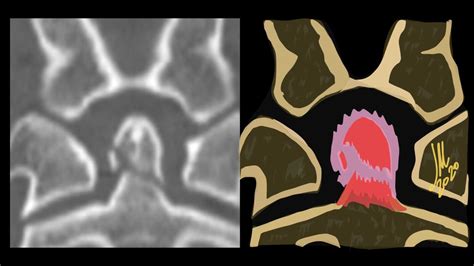 Odontoid type 2 fracture - NeuroRad911 Odontoid type 2 fracture