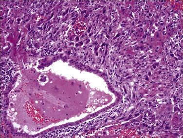 Gestational Trophoblastic Disease | Basicmedical Key