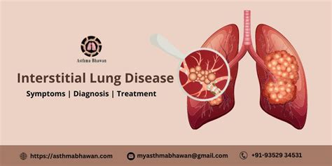 Interstitial Lung Disease(ILD) | Symptoms, Diagnosis and Treatment